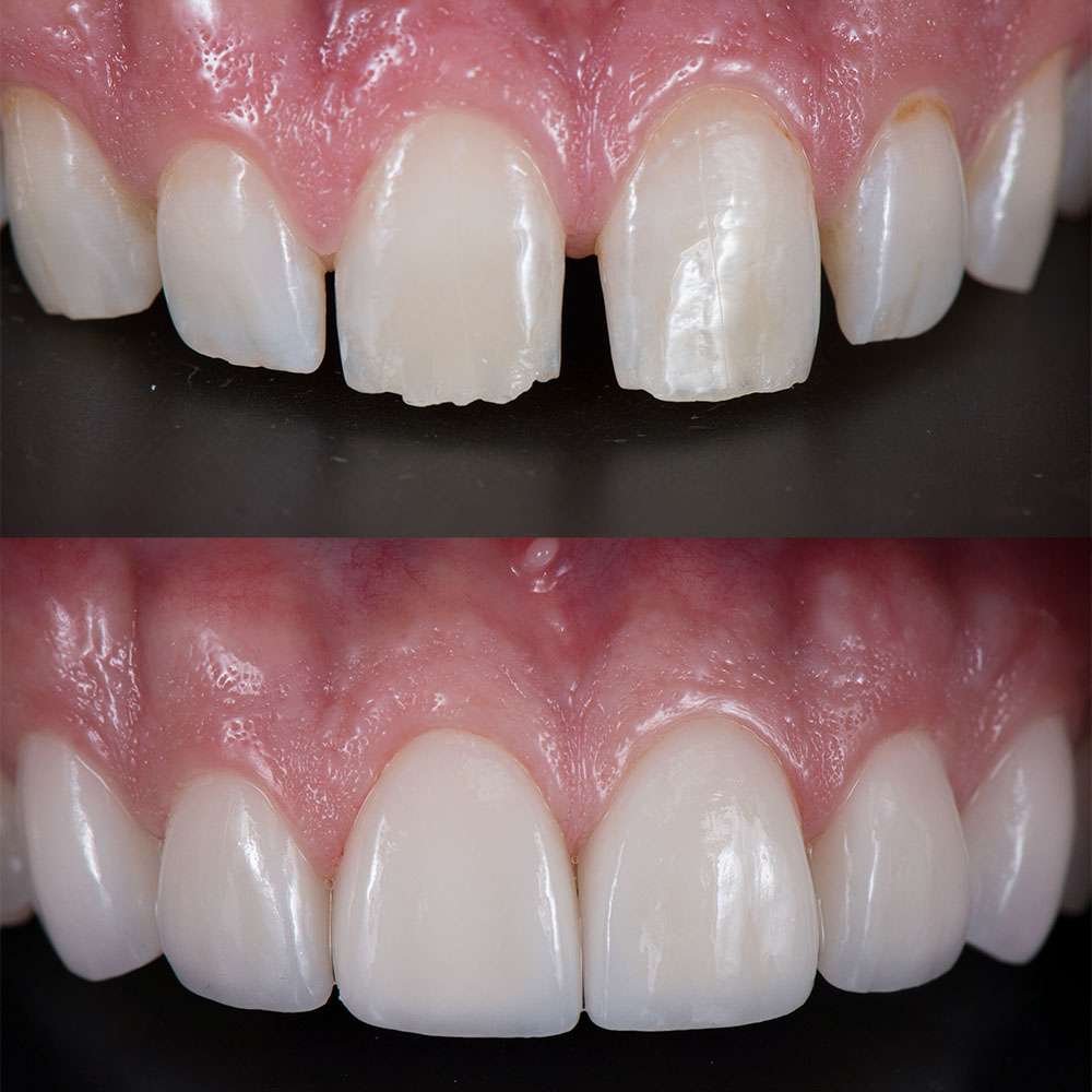 Can Composite Bonding Fix Crooked Teeth Can Composite Bonding Fix Crooked Teeth